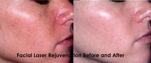 Laser Rejuvenation Facial